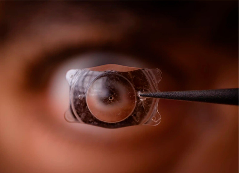 Lentes fáquicas ICL