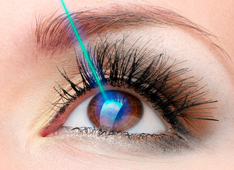 Cirugía refractiva LASIK/PRK
