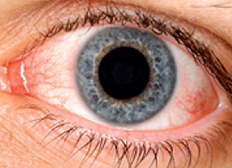 Tratamiento del ojo seco